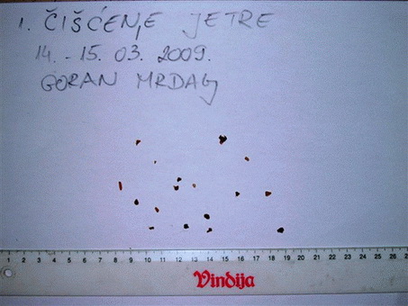 Žućni kameni primjeri žučni kamenci primjeri